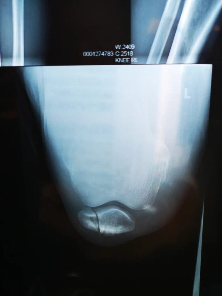 Patella Fracture Xray Up Clinic Shanghai